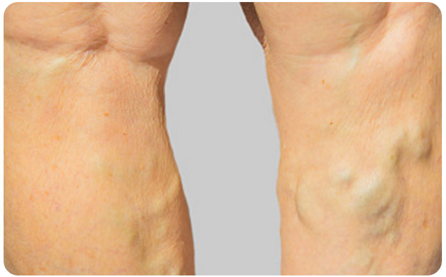 cirugia vascular