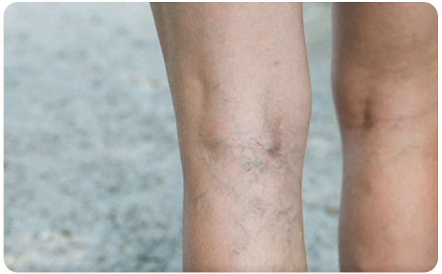 que son las varices