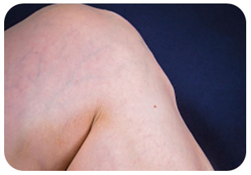 padeces de varices