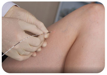 varices